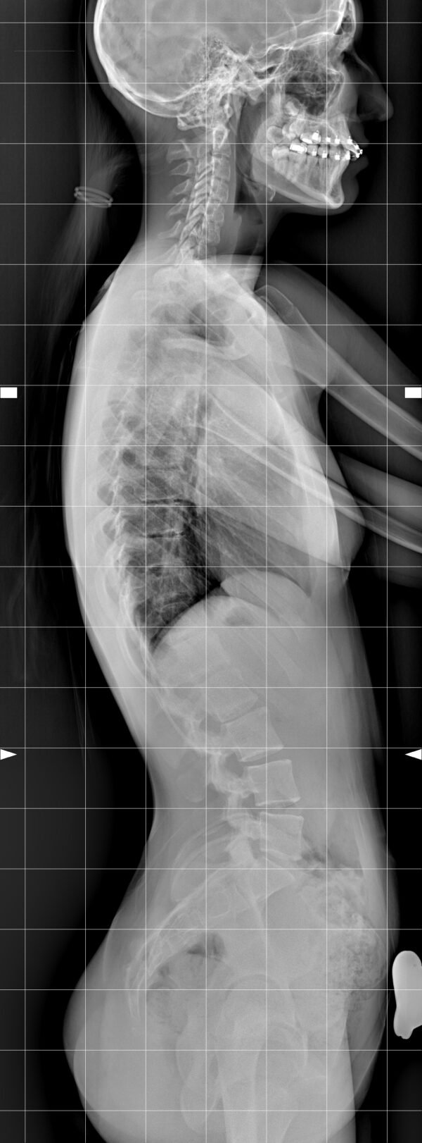 scoliosi sinapsi riabilitazione
